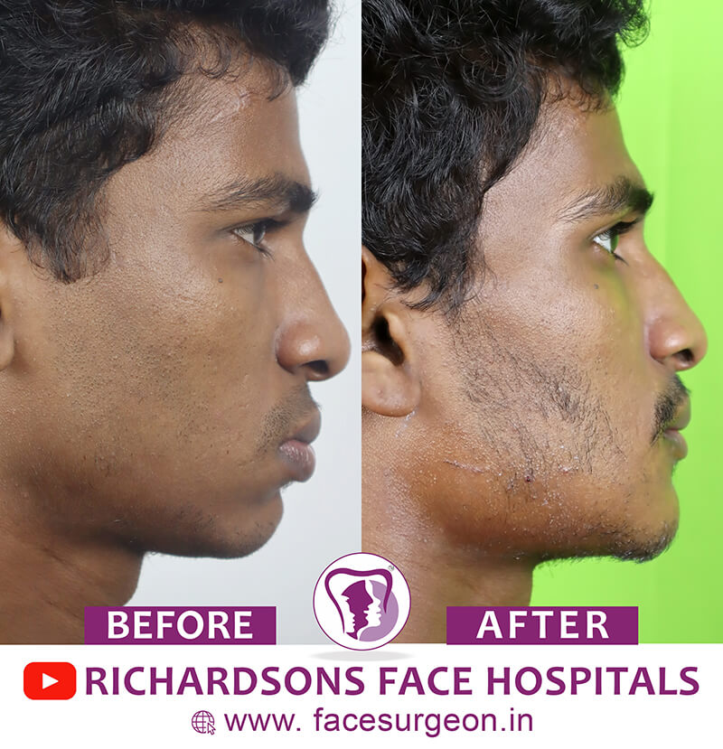 Genioplasty Before After Side View