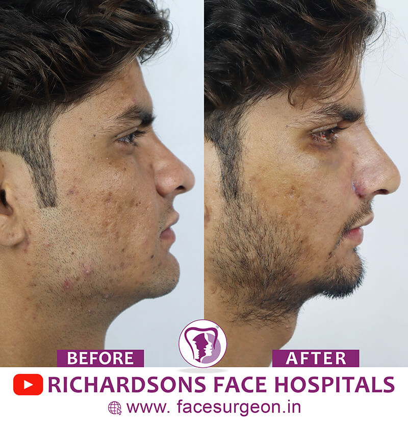 Rhinoplasty side view