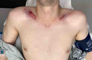 Male clavicle lengthening intraop 2 Dr Barry Eppley Indianapolis 2 300x197