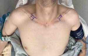 Male clavicle lengthening intraop 1 Dr Barry Eppley Indianapolis copy 300x193