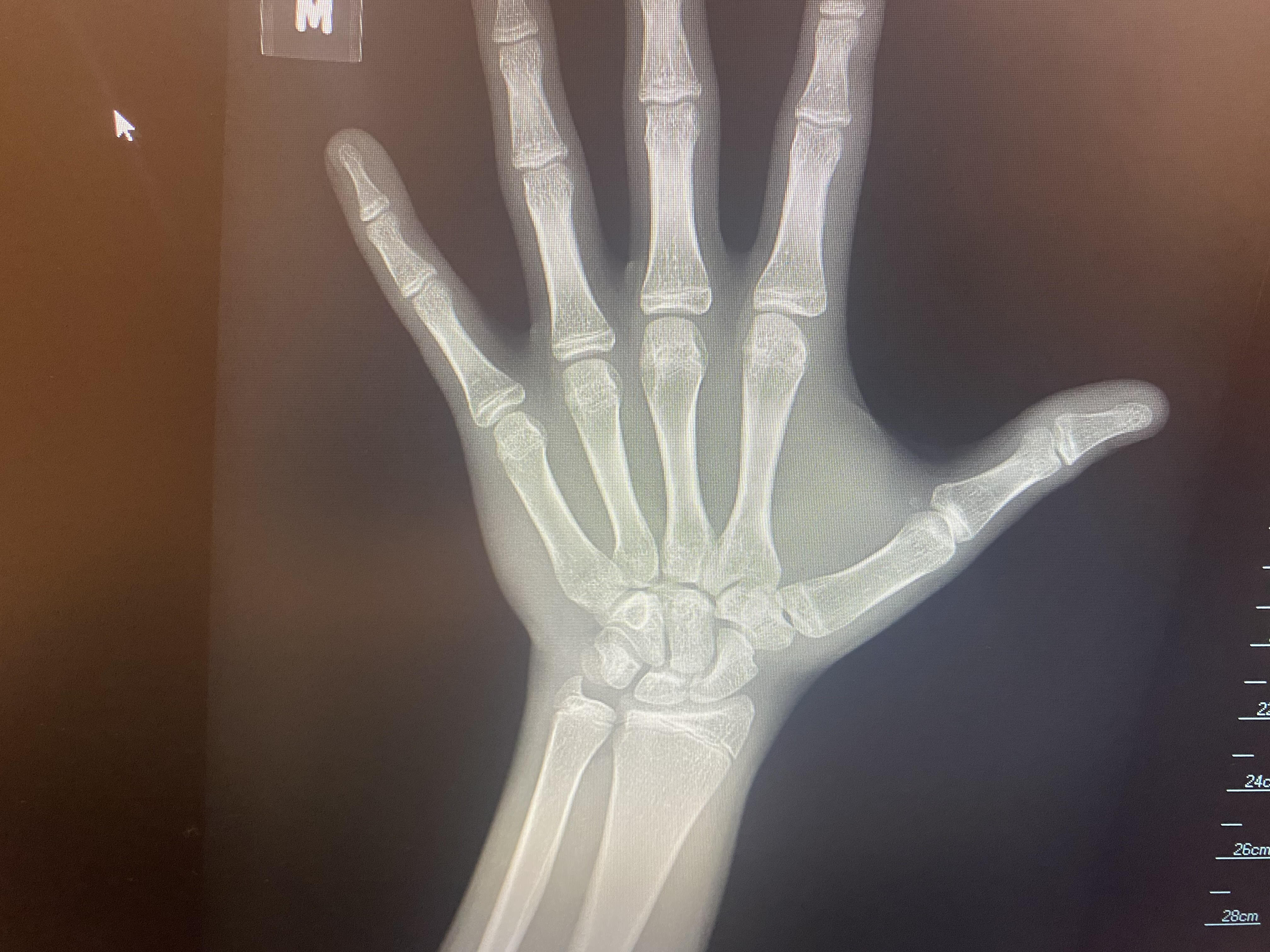 Wrist 1 1