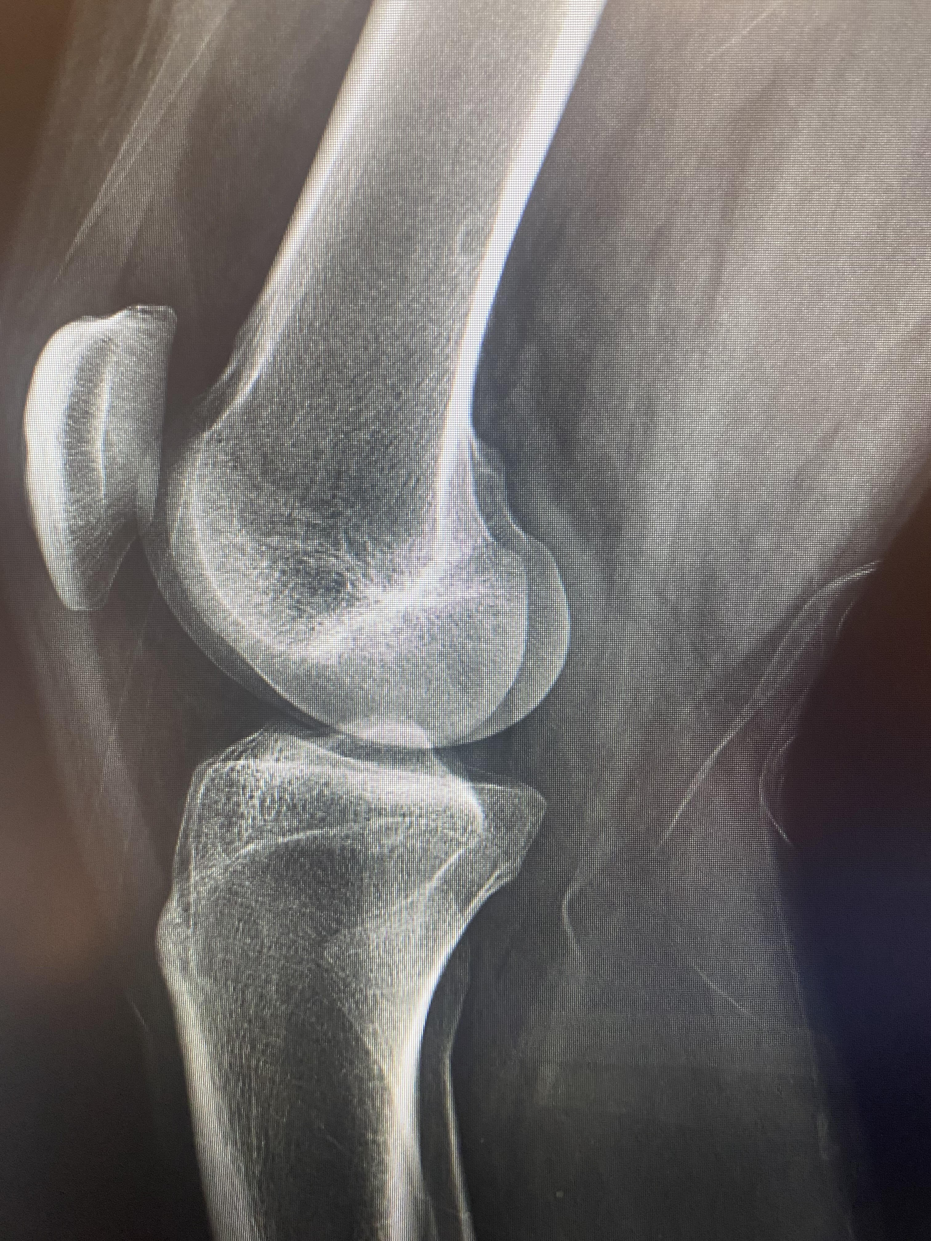 Femur side 1