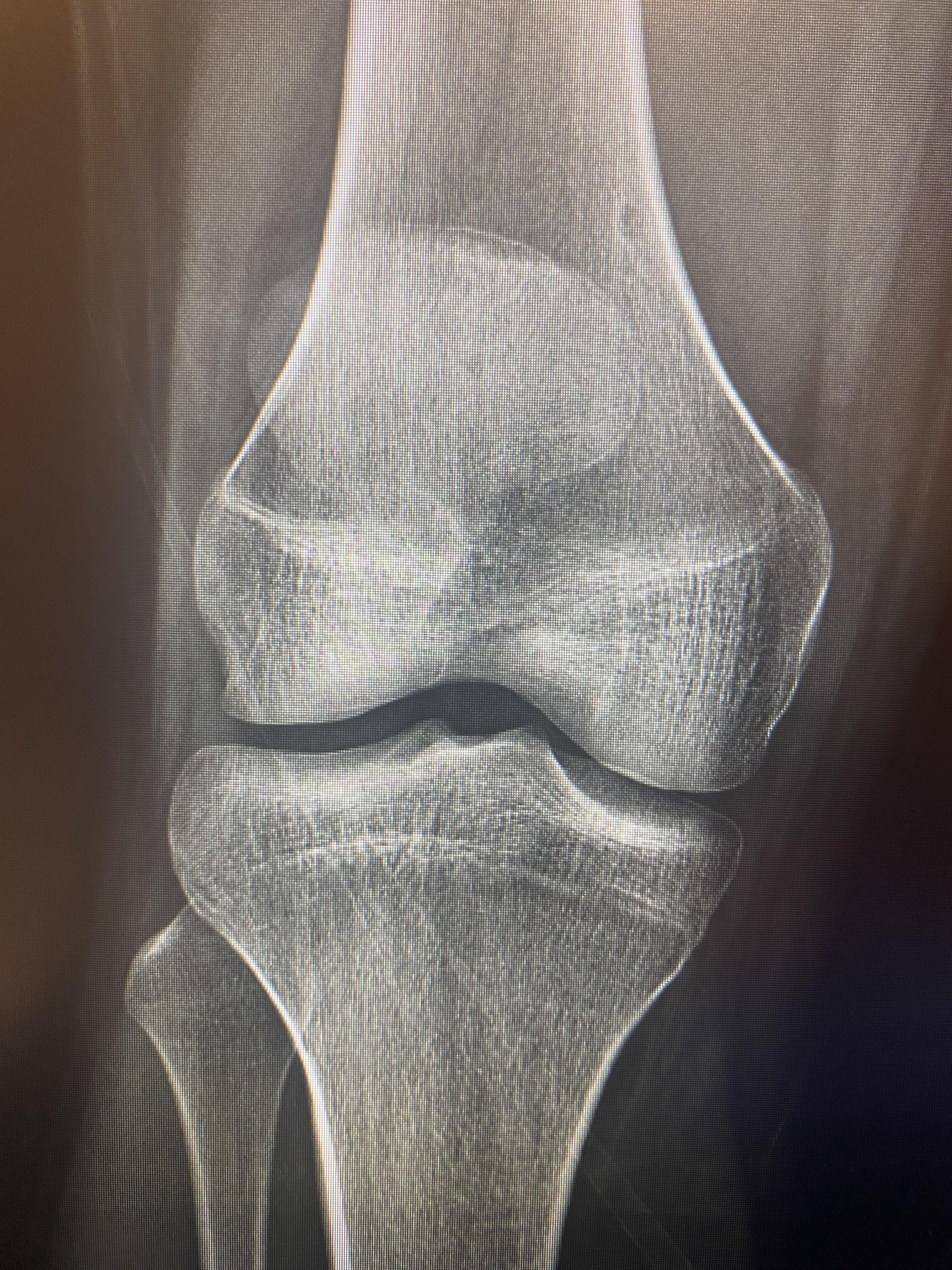 Femur front 1 1
