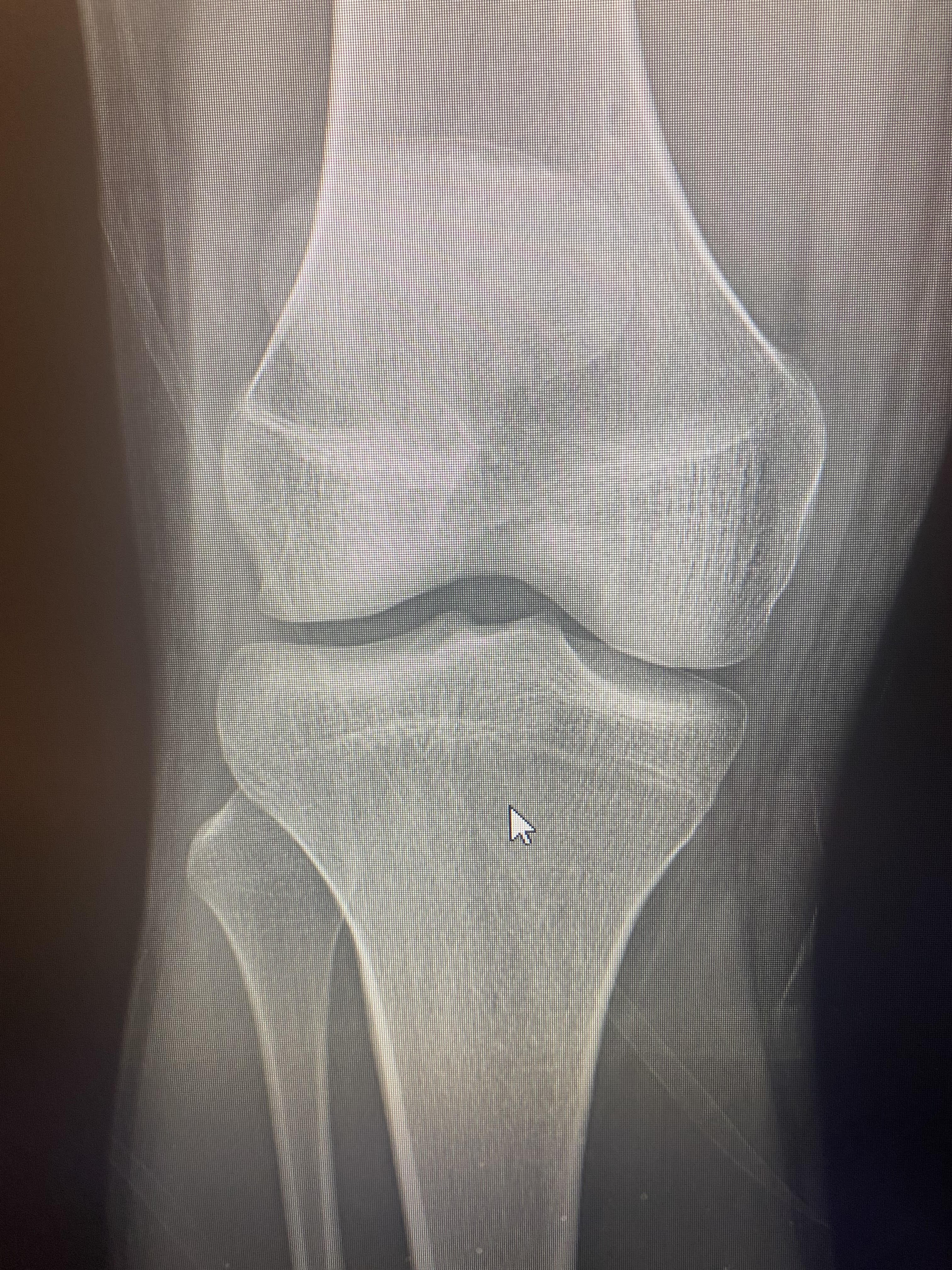 Femur front 2 1