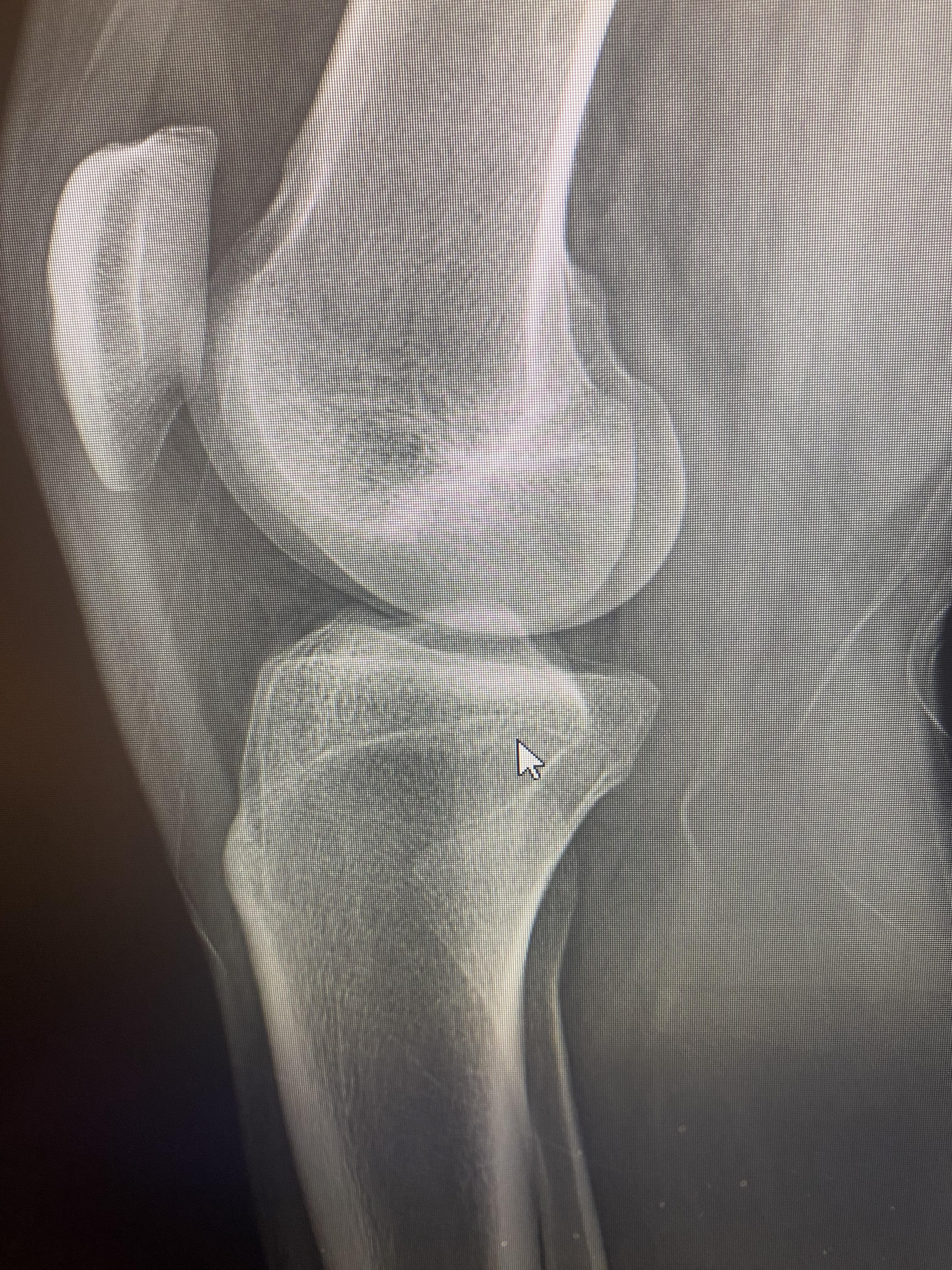 Femur side  2 1