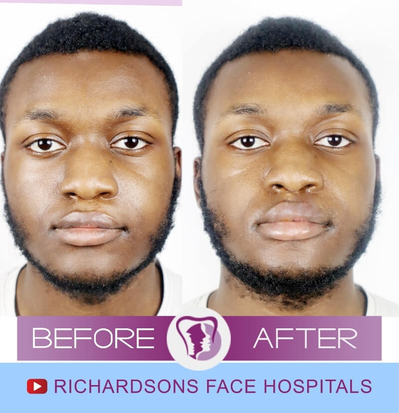 Nathan Lip Correction Surgery
