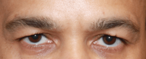 why-correct-hooded-eyes-300x300~2.png