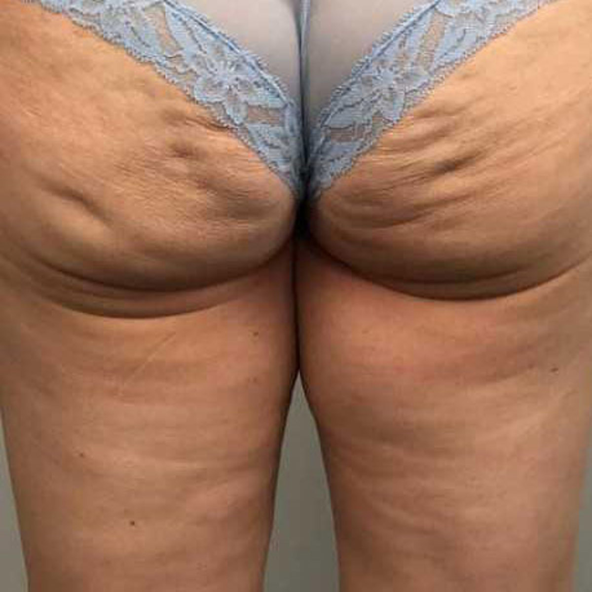 Cellulite
