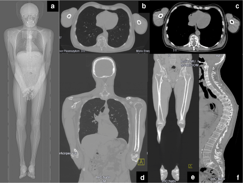 Mage examples of a whole body low dose CT scan a scout Images were reconstructed in 1