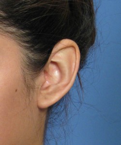 Macrotia2ObliqueBefore 250x300