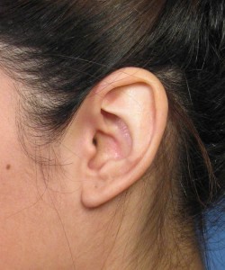 Macrotia2LateralBefore 250x300 1