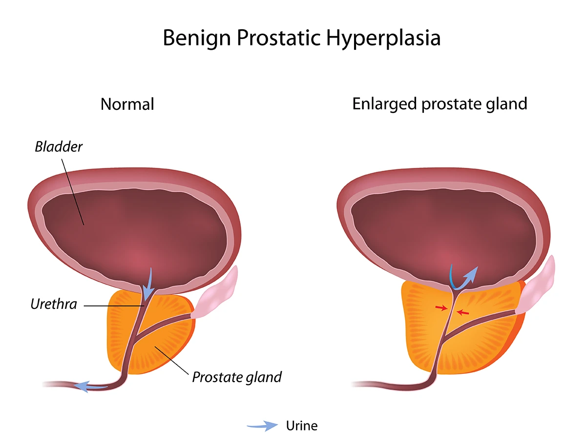 Benign prostatic hyperplasia