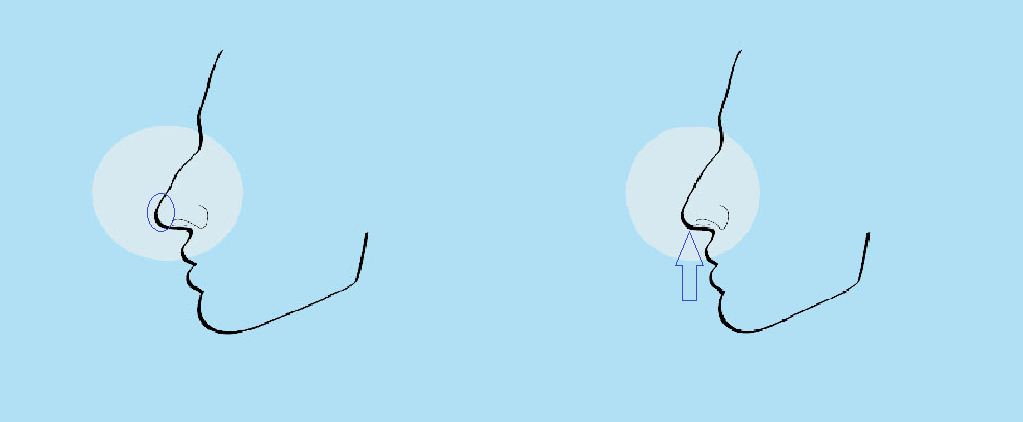 Hydrocortisone areas