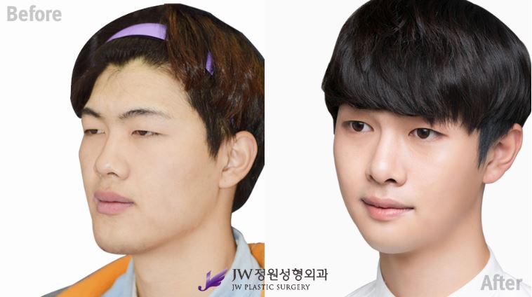 Face bone contouring surgery complication 2