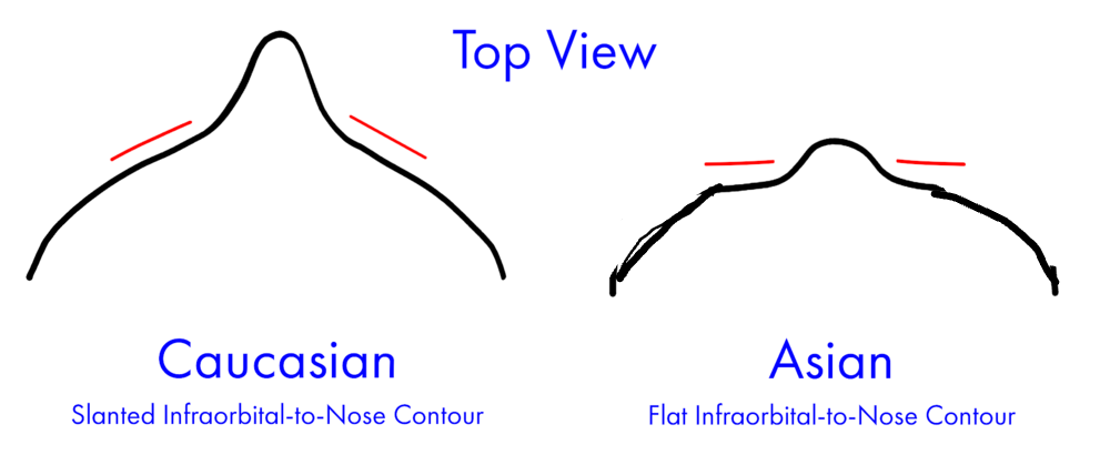2305734 Forward Maxilla Is a Projected Nasal Area