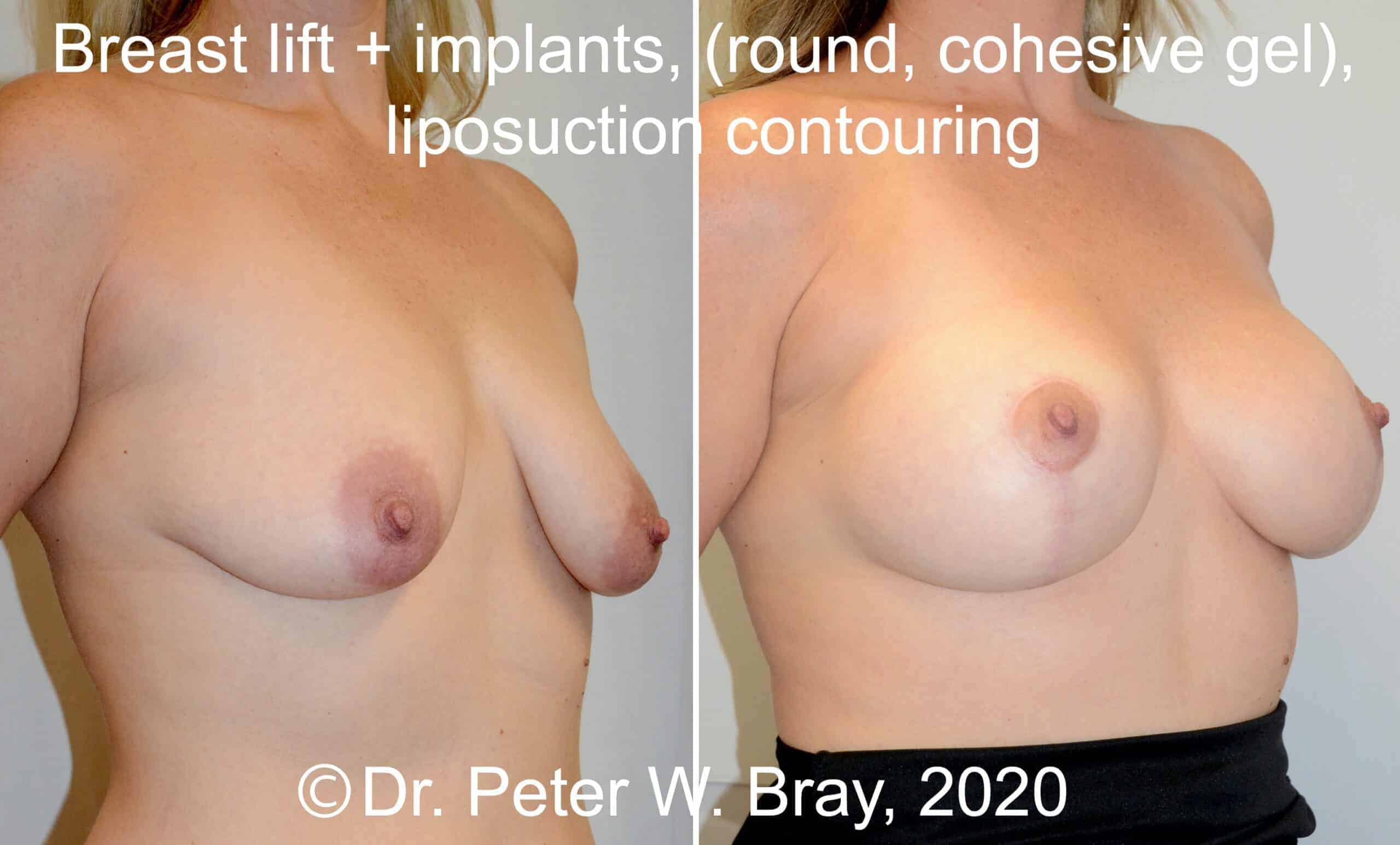 Image3 surgical breast breast lift Dr Bray scaled