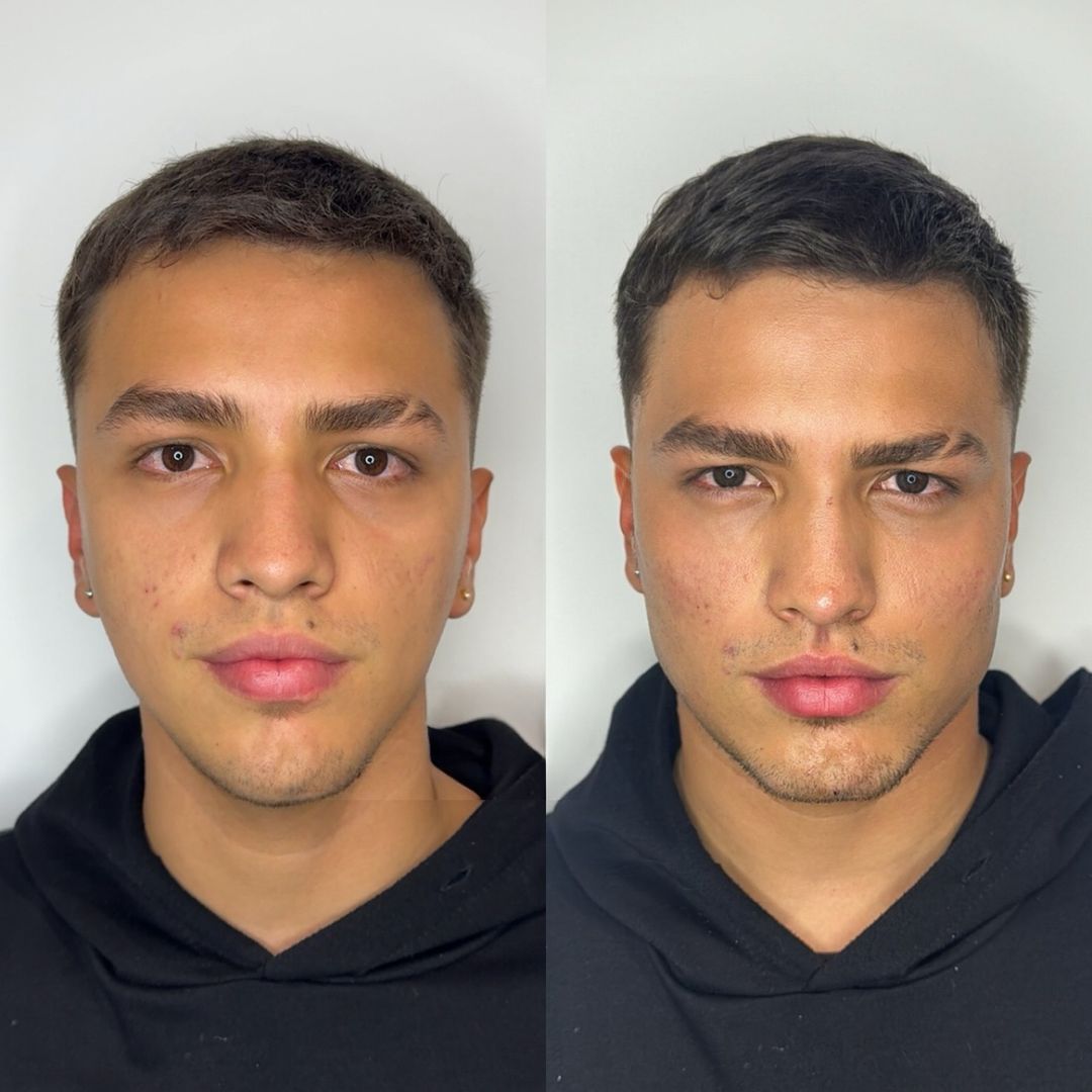 Masculinizacin facial Cambio de nio a