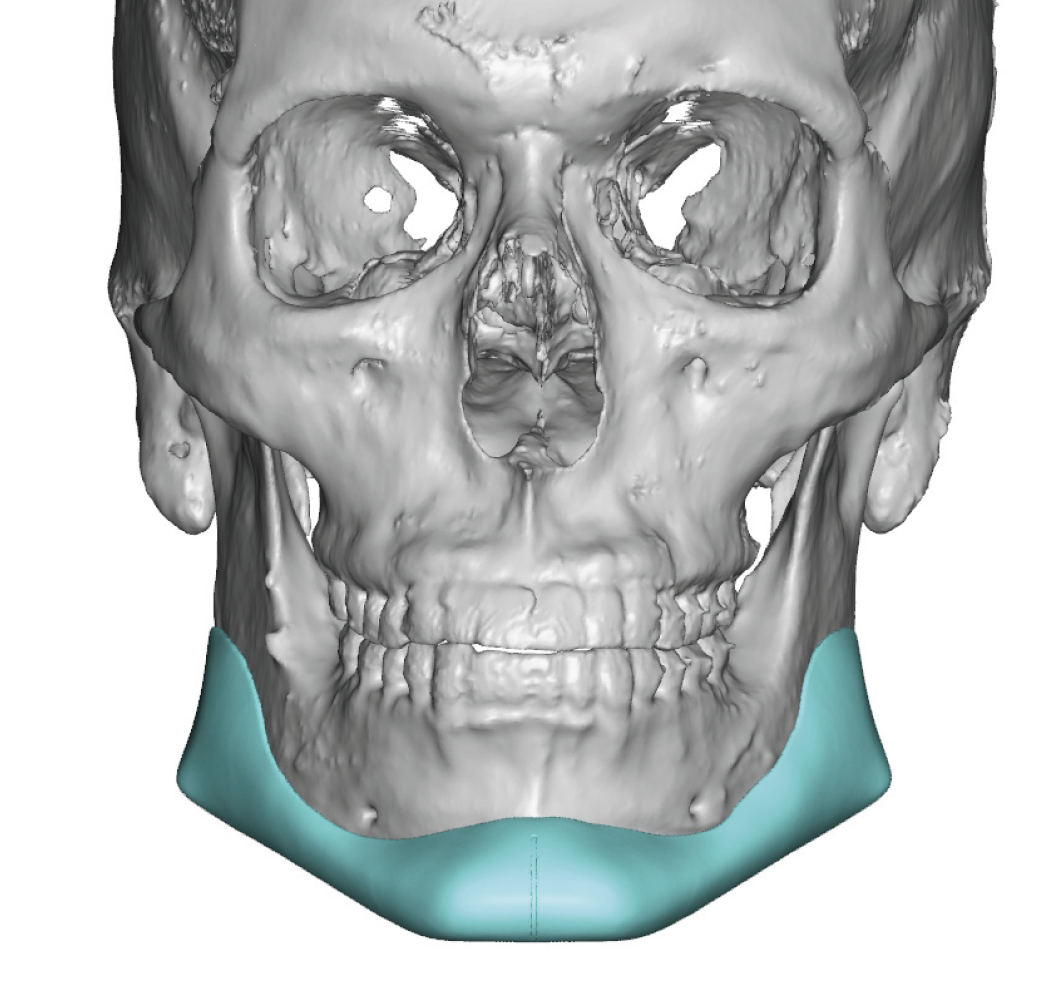 Angular jawline implant design front view Dr Barry Eppley Indianapolis