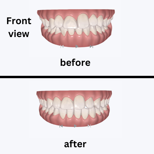 Before Before