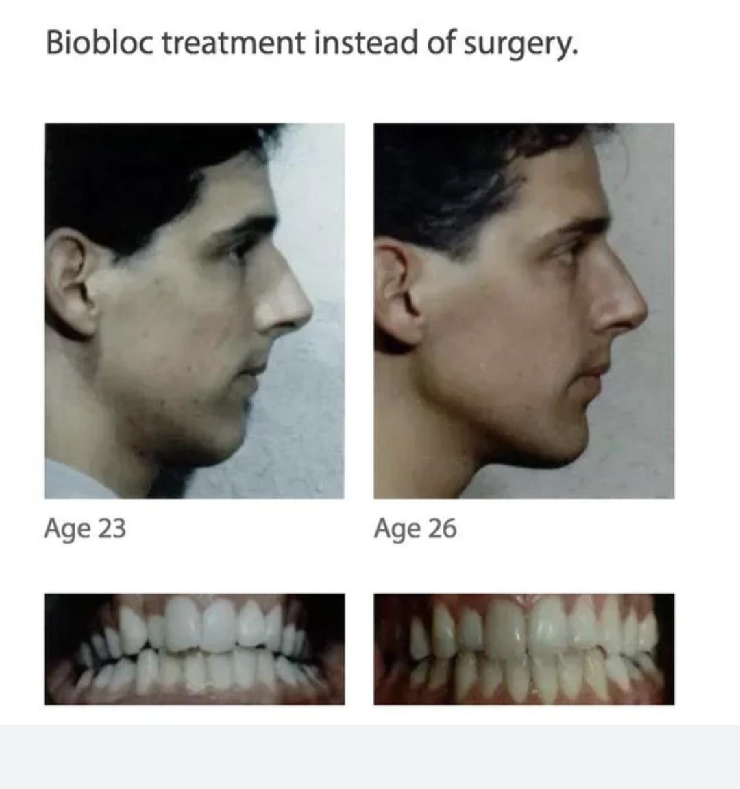 Biobloc 2 Biobloc 2