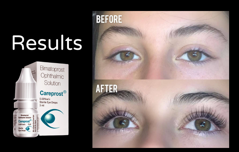 Careprost Result