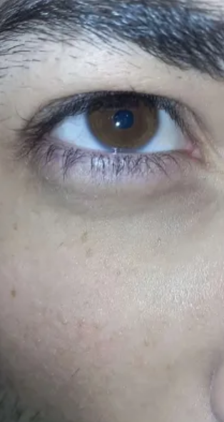 Eye