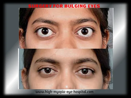 Bulging eye treatments 500x500