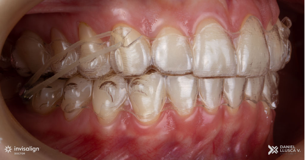 Invisalign Post Copy 1 1024x537