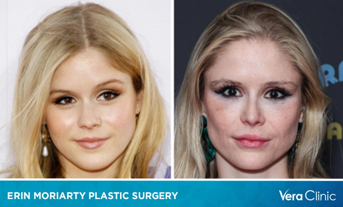 Erin moriarty plastic surgery