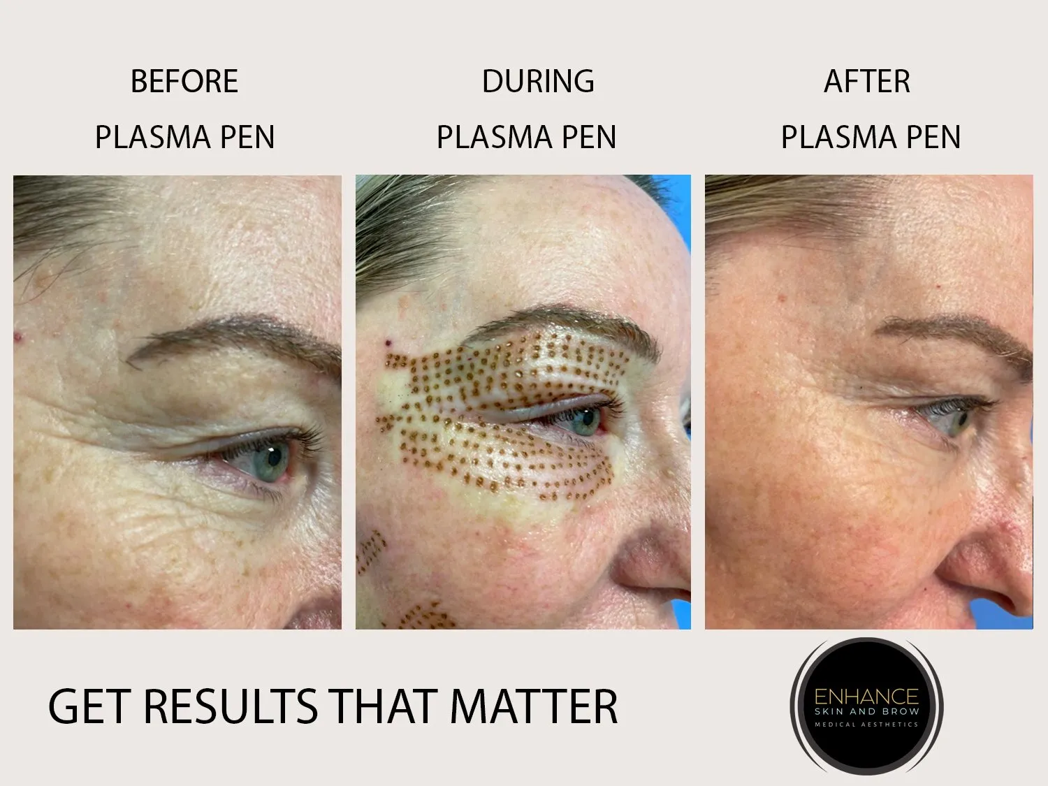 Plasma Pen Enhance Skin and Brow eyes 1
