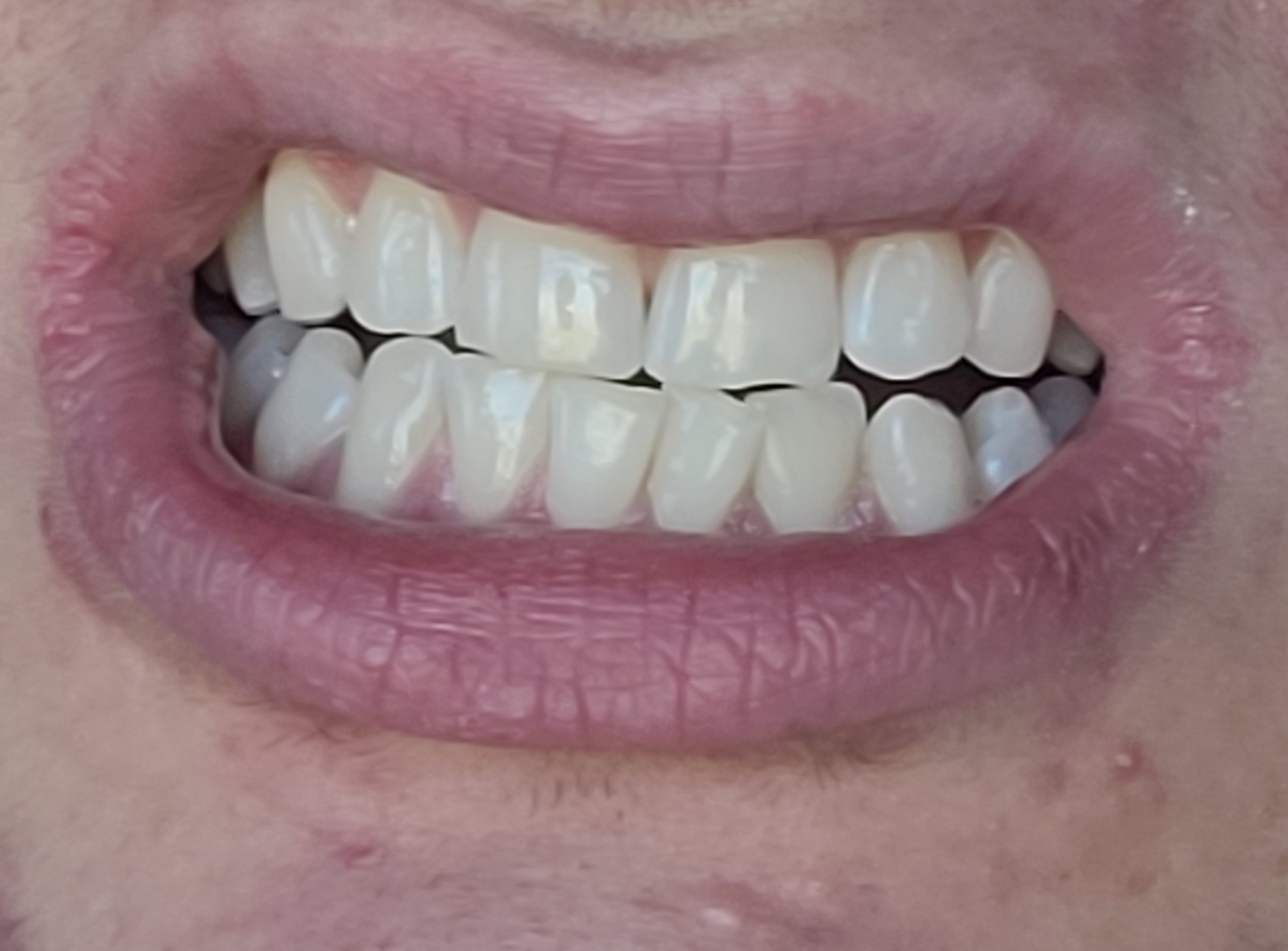 After whiteing