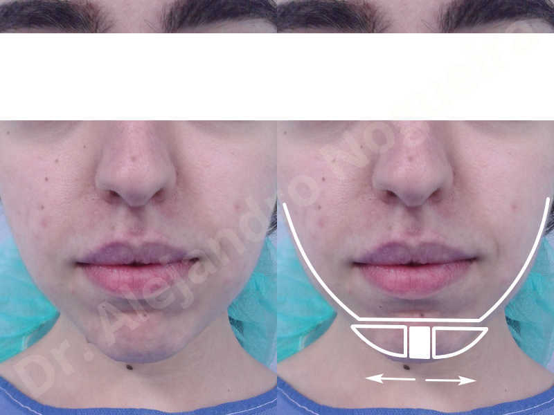 Sliding genioplasty chin augmentation 1