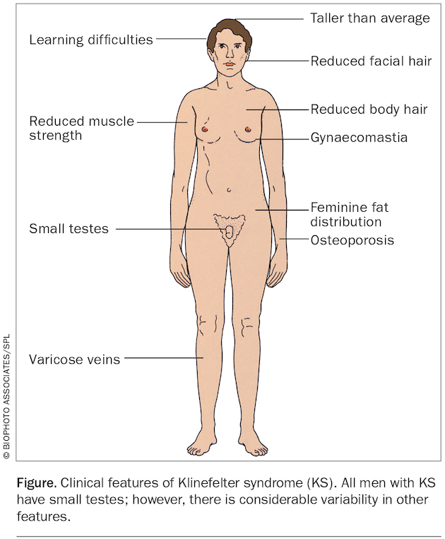 F Klinefelter syndrome Upreti