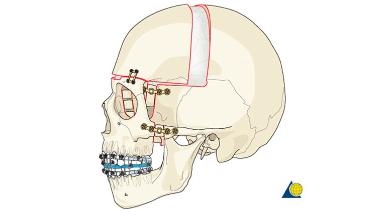 Monobloc advancement procedure demonstration craniofacial surgical management revised july 201