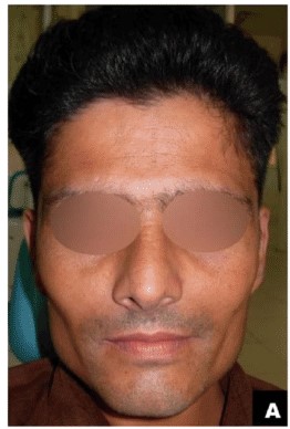 Clinical expressions of Oral Submucous Fibrosis Oral Submucous Fibrosis in a 27 year old