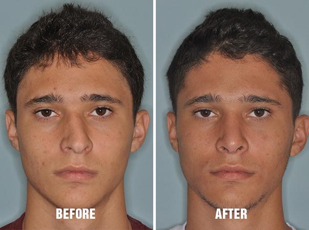 Rhinoplasty before after 9