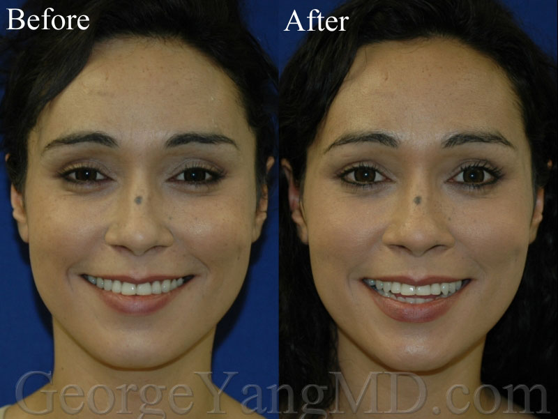 Upper Filler BA 4 002WM copy