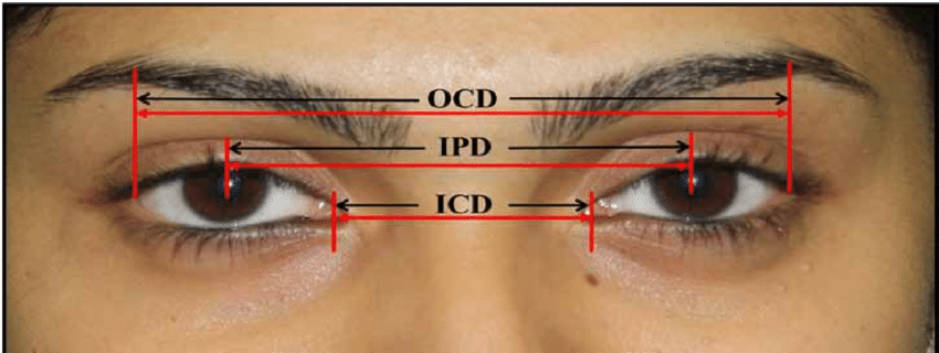 Canthal medial and lateral and interpupillary distance measurements OCD Distance