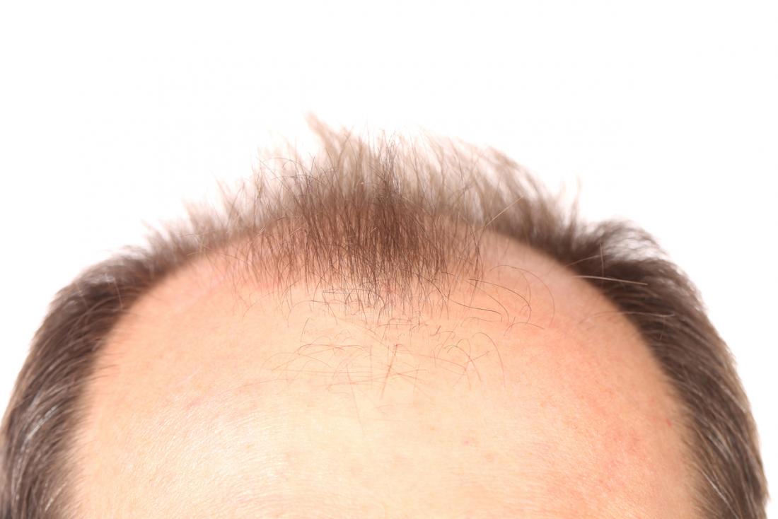 Top of head with receding hairline