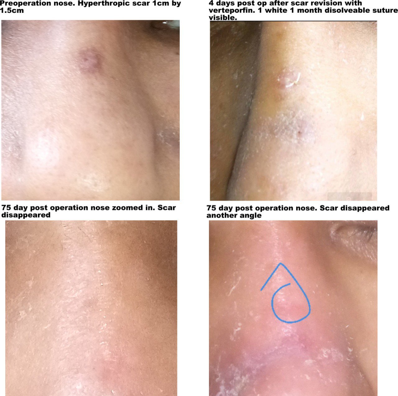 Verteporfin result