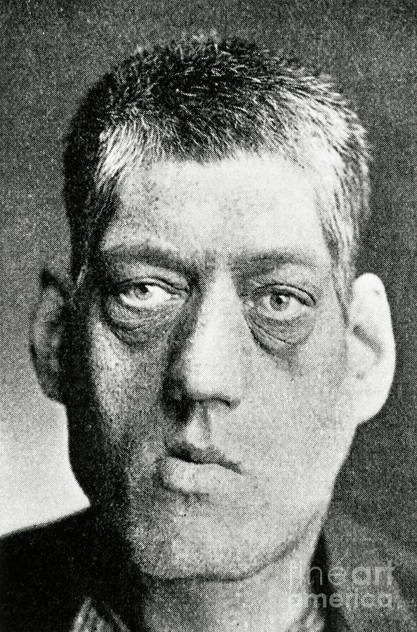 Acromegaly science photo library