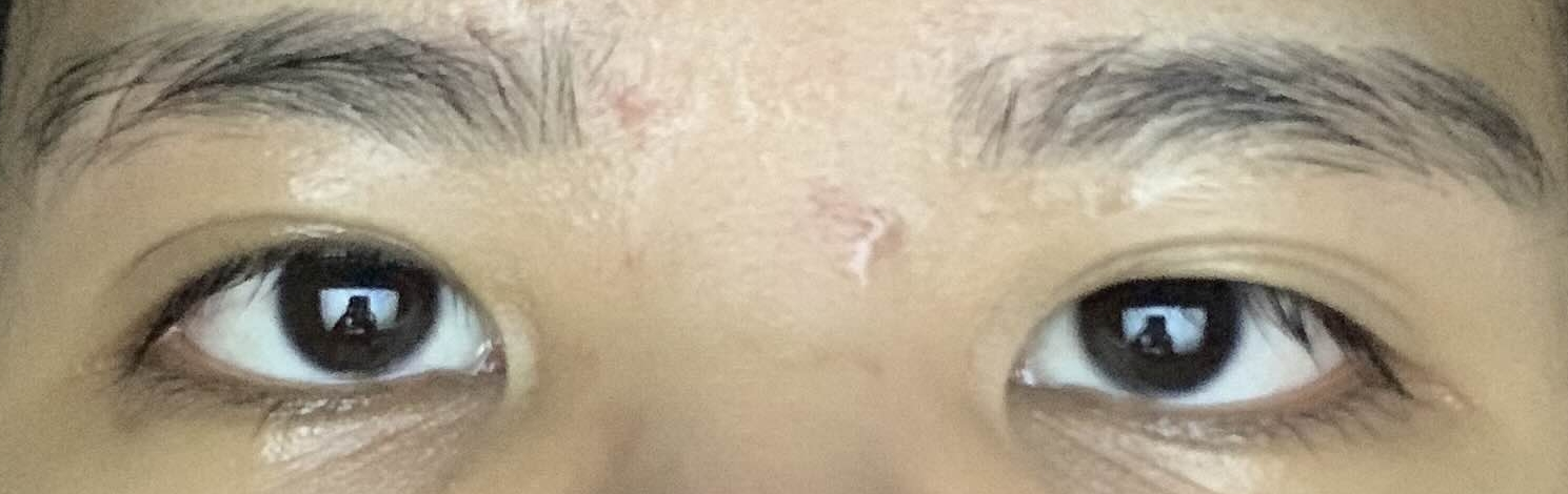 Eyelids
