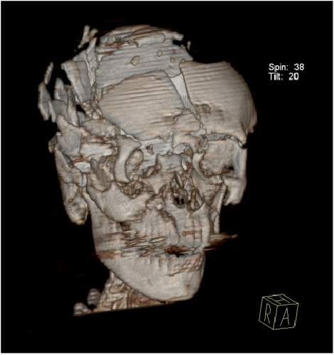 Severe cranial fracture in a 25 year old car driver who suffered