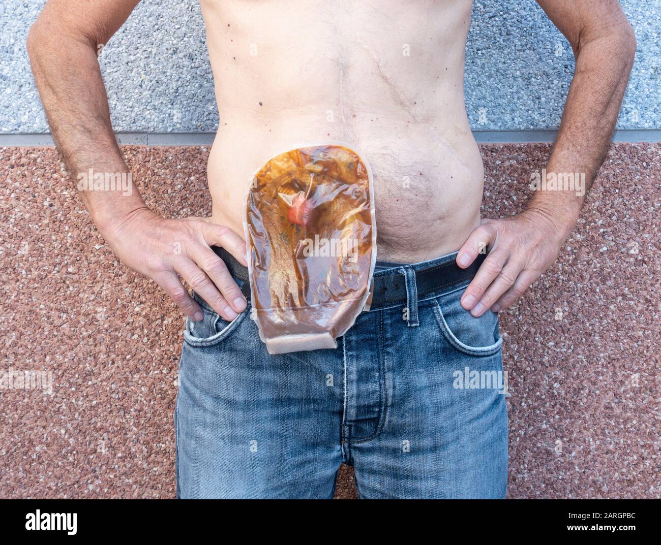 Mature man with stoma wearing transparent ileostomy bag see image 2argpbt for new empty bag af