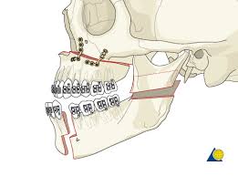 ‪Idea for complete jaw improvement (angle, occlusion, advancement)‬‏