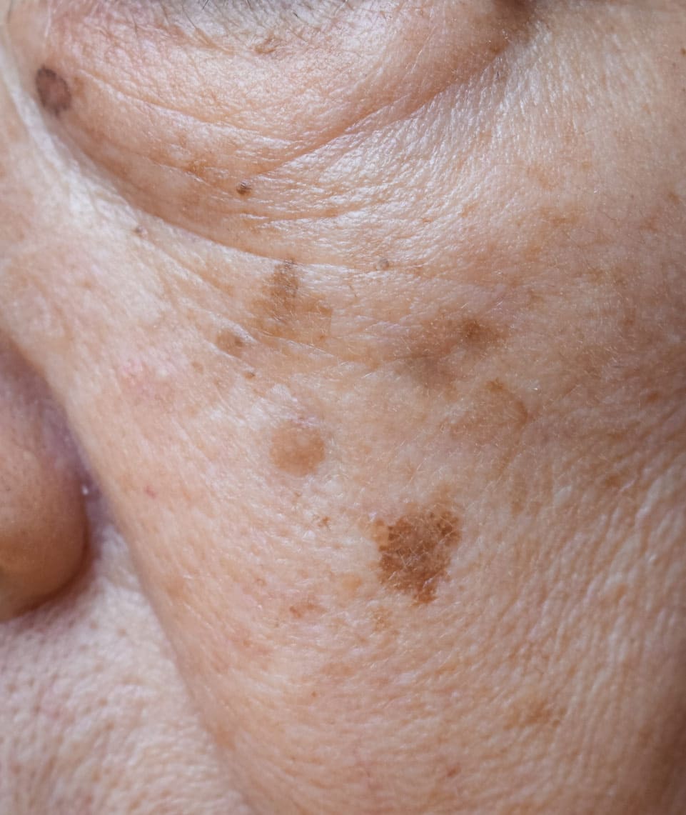 Dr grace kelly your conditions skin age spots