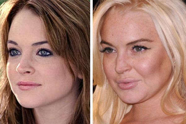 Lindsay Lohan Plastic Surgery Before After