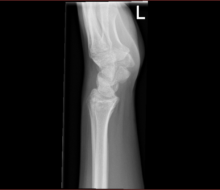 Charlie x ray 2