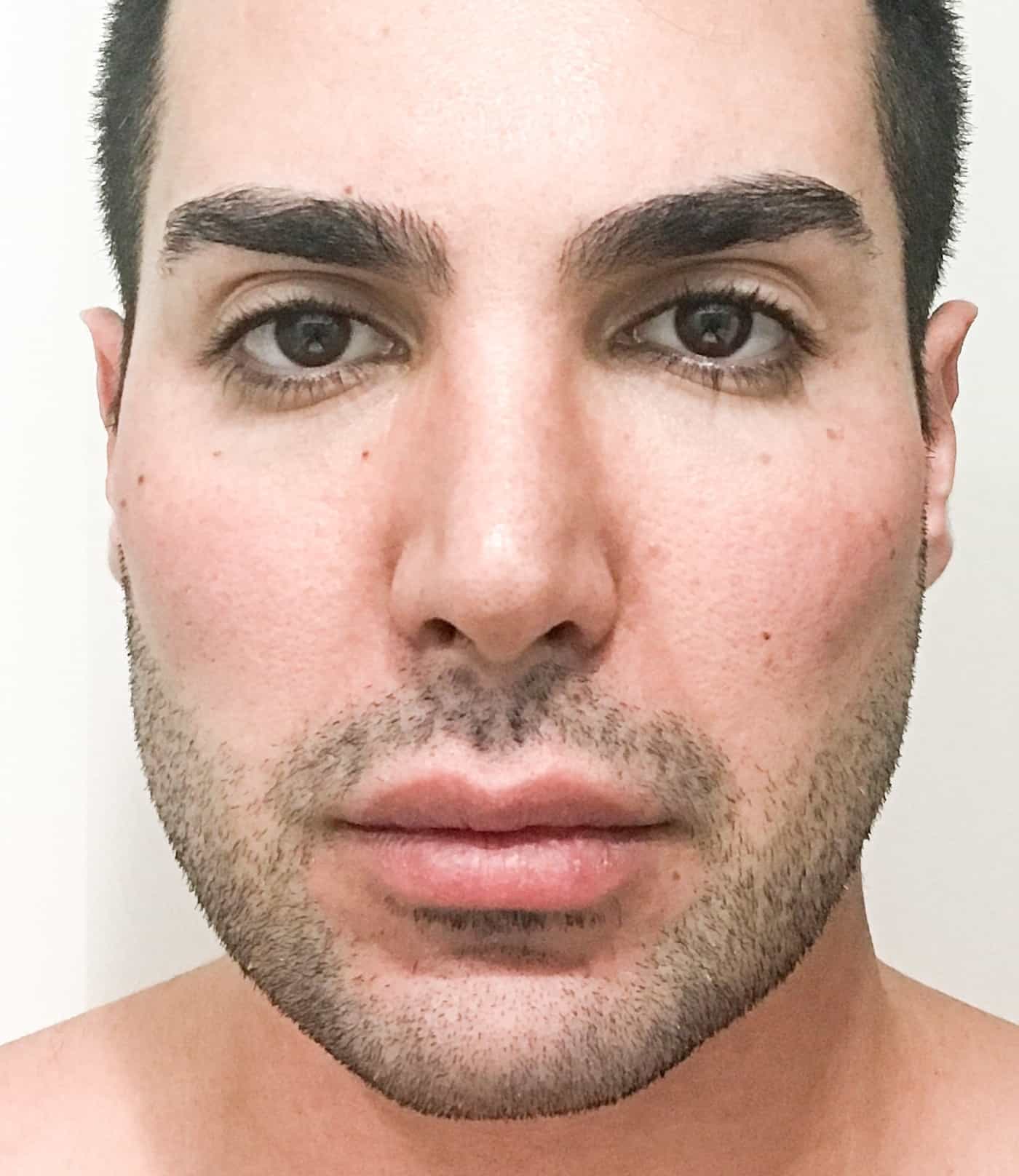 Custom Facial Implants 14a custom chin implant before Dr Barry Eppley Indianapolis