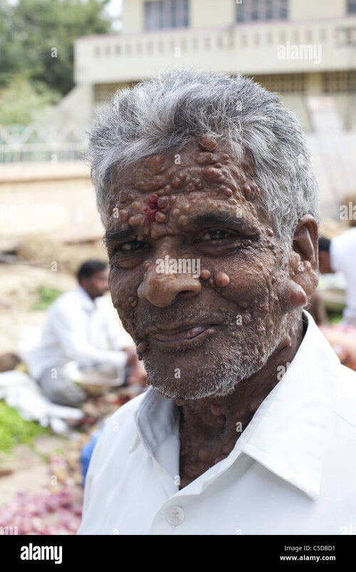Man with lumps and bumps on his face C5DBD1